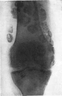 Хондроматоз коленного сустава, фото