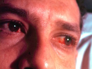 Глаза при реактивном артрите