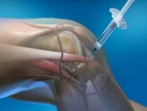 Изображение - Анестезия при артроскопии коленного сустава anestezija-pri-artroskopii-kolennogo-sustava-300x227