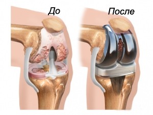 Эндопротезирование для лечения колена при остеоартрозе