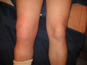 Надрыв связок коленного сустава