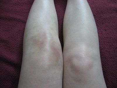 Деформация коленного сустава при полиартрите