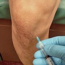 Пункция коленной жидкости при полиартрите
