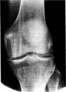 Снимок артропатии колена