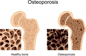 Схематичное изображение остеопороза