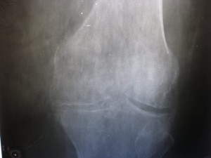 Снимок сустава с остеопорозом