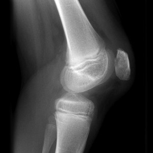 Рентгеновский снимок коленного сустава с хондромаляцией