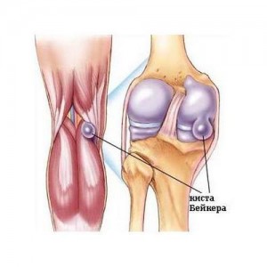Схематичное изображение кисты в колене