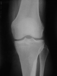 Остеосклероз колена, рентгеновский снимок