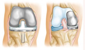 Эндопротезирование сустава колена