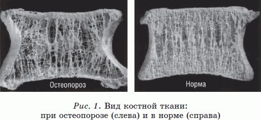 Фото костной ткани при остеопении и остеопорозе