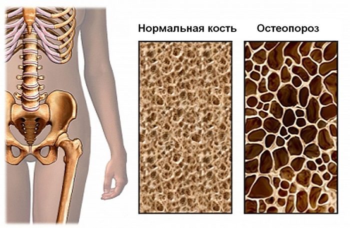 Изменения в кости при остеопении и остеопорозе